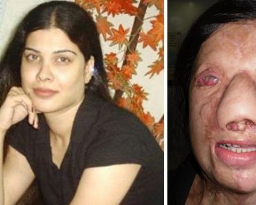 Woman From Pakistan Suffers Ghastly Acid Attack From Jealous Friend, But Skillful Surgery Salvages Her Face