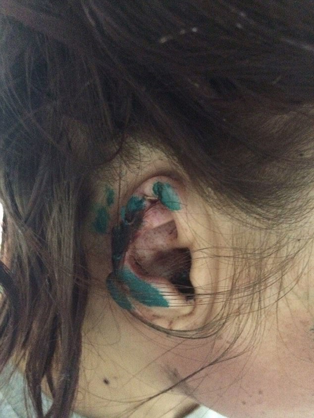 man bites off nurse's ears
