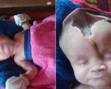 Baby Girl Born With Part Of Her Skull Missing